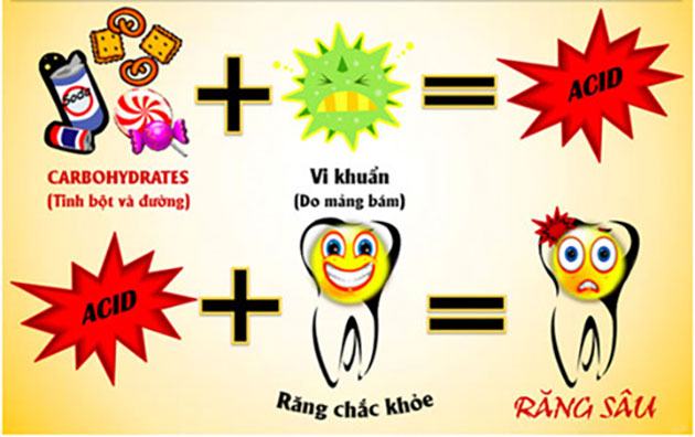 Nguyên nhân gây sâu răng nhẹ đến nặng