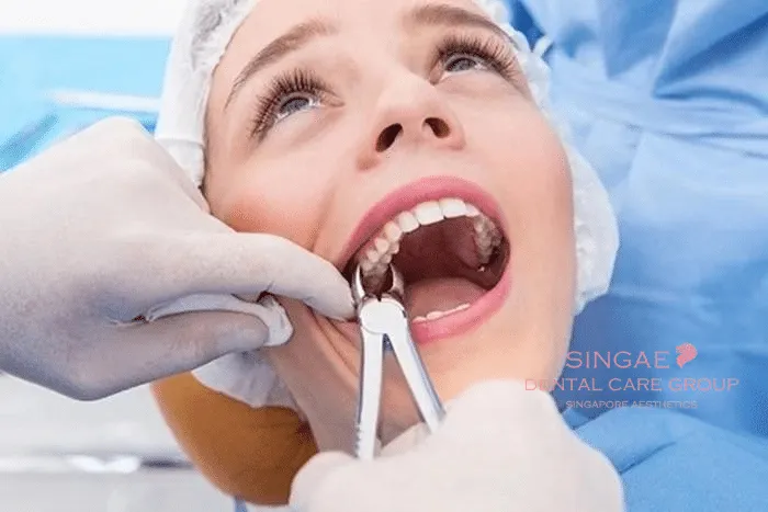 Nhổ răng có nguy hiểm không