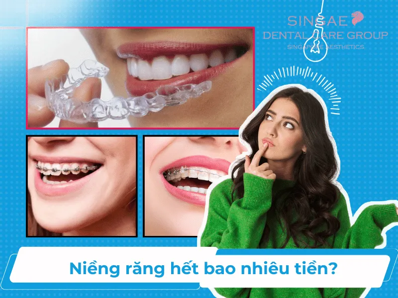 Niềng răng bao nhiêu tiền