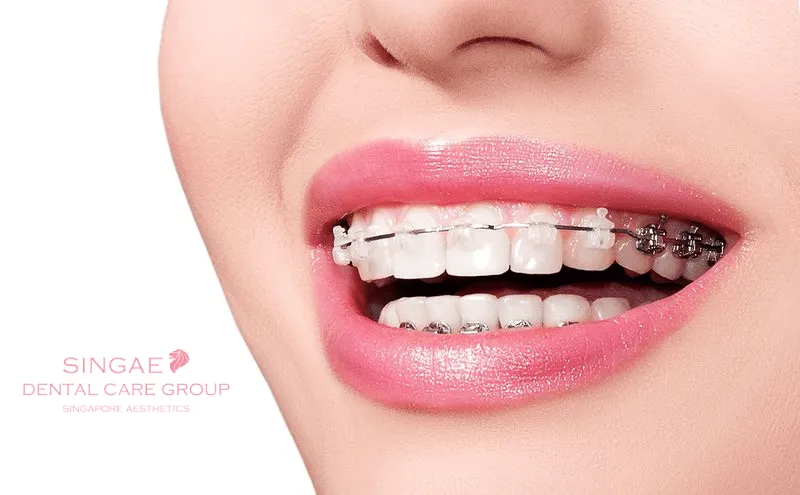 Niềng răng là gì? Khi nào nên niềng, quy trình và chi phí