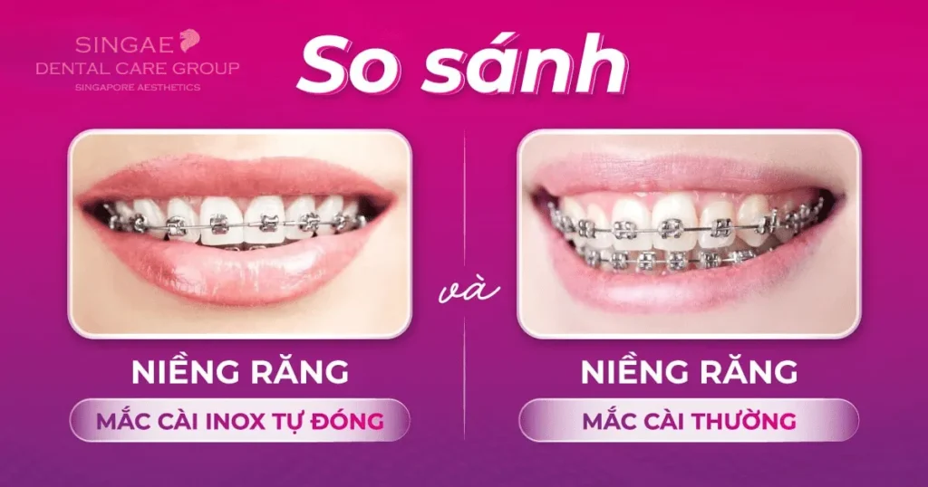 Niềng răng mắc cài tự động