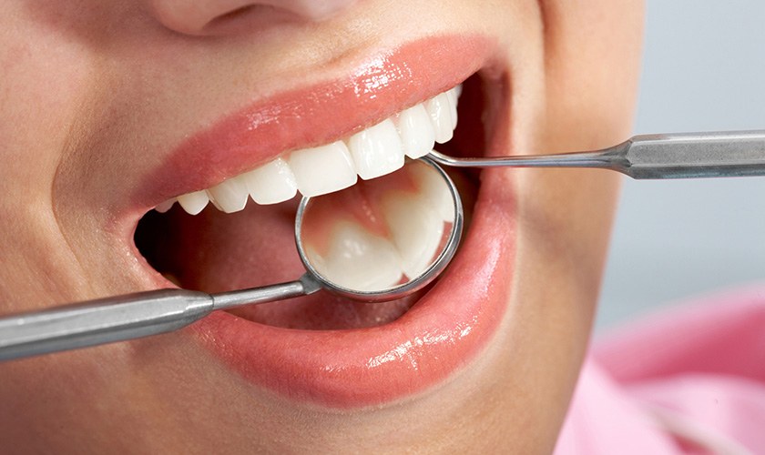 Phương pháp chữa trị sâu răng phổ biến hiện nay