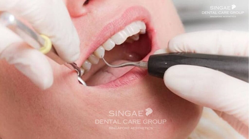 Quy trình lấy cao răng tại nha khoa Singae