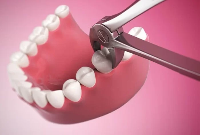 Răng sâu bị vỡ phải nhổ