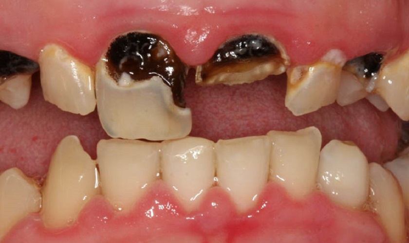 răng sâu bị vỡ