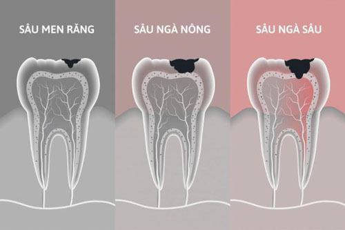 Sâu ngà răng