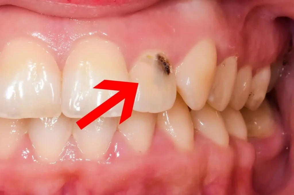Sâu răng cửa là gì? Nguyên nhân và cách ngăn ngừa 6 Sâu răng cửa là gì