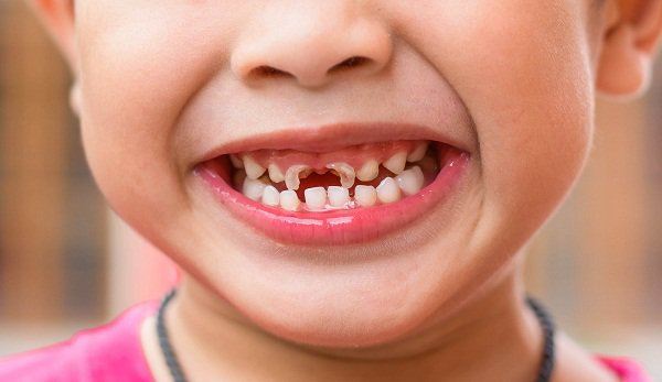Sâu răng trẻ em: Dấu hiệu, nguyên nhân, cách điều trị !