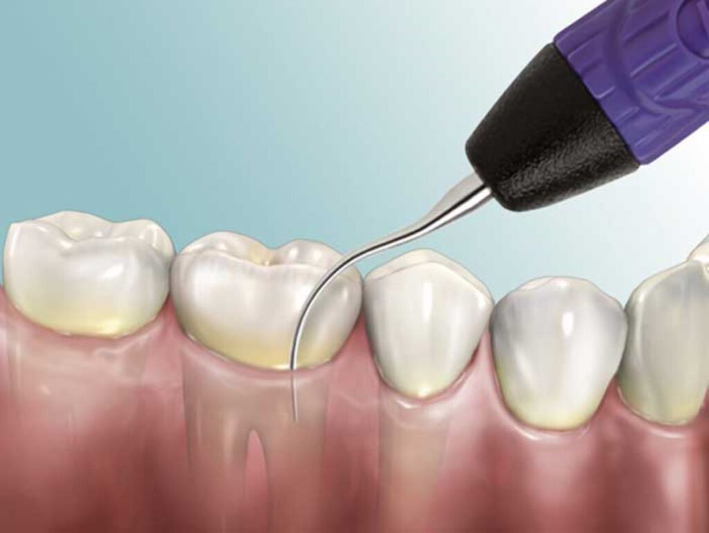 Có nên dùng máy lấy cao răng tại nhà không? Loại nào tốt 8 Sử dụng máy lấy cao răng tại nhà có hiệu quả không
