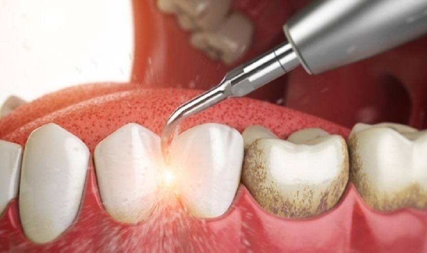 Tác hại của việc lấy cao răng? Lợi ích và cách phòng ngừa