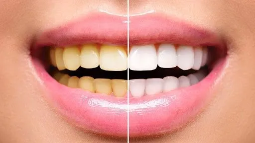 Tẩy trắng răng có tốt không