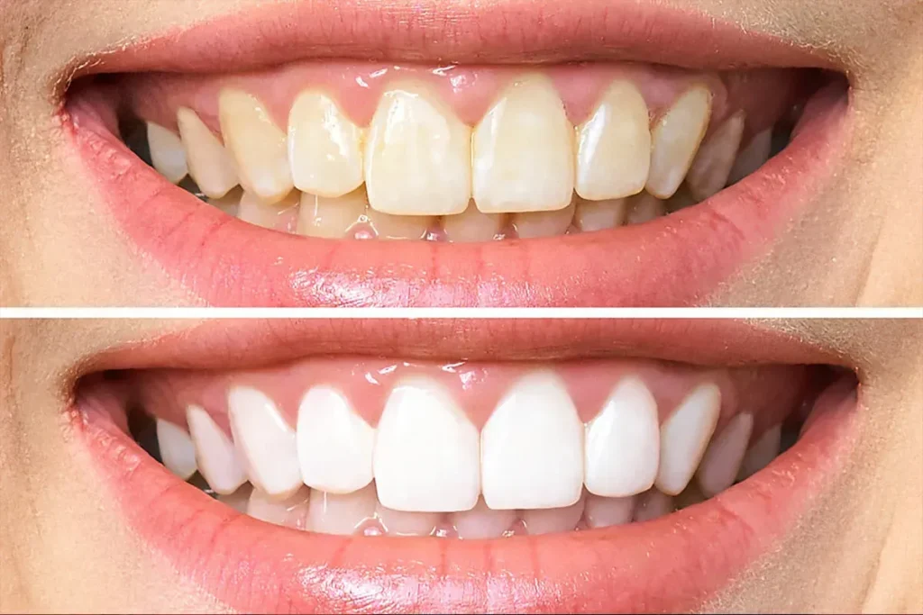 Tẩy trắng răng duy trì được bao lâu