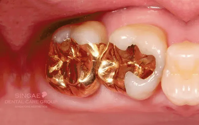 Trám răng bằng kim loại