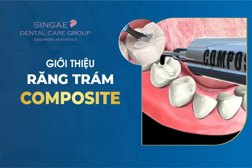 Trám răng bằng vật liệu Composite