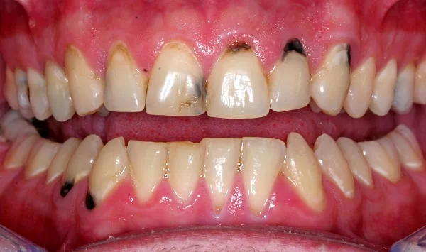 Triệu chứng khi bị sâu chân răng