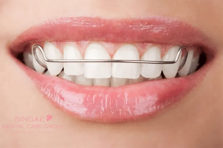Ưu điểm hàm duy trì Hawley