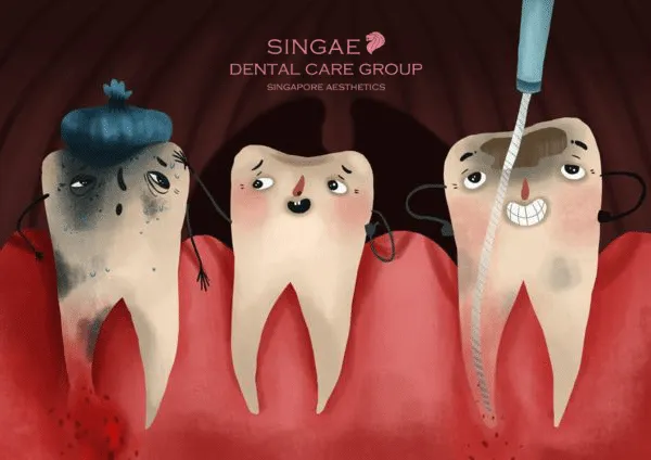 Điều trị tủy răng là gì? Những thông tin bạn nên biết 10 Vì sao phải điều trị tủy răng