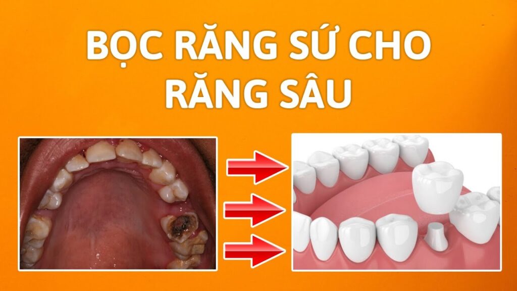 Sâu răng hàm : Các mức độ và cách điều trị dứt điểm 11 bọc sứ cho răng hàm bị sâu