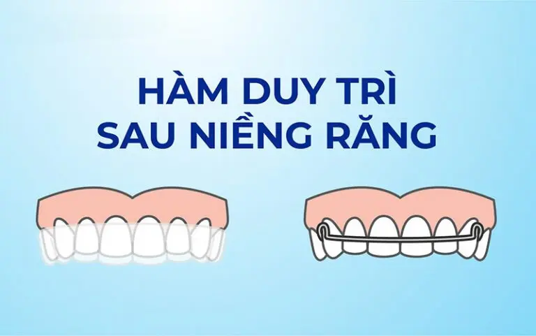 Hàm duy trì là gì? Có mấy loại? 5 điều bạn nên biết ! 6 hàm duy trì