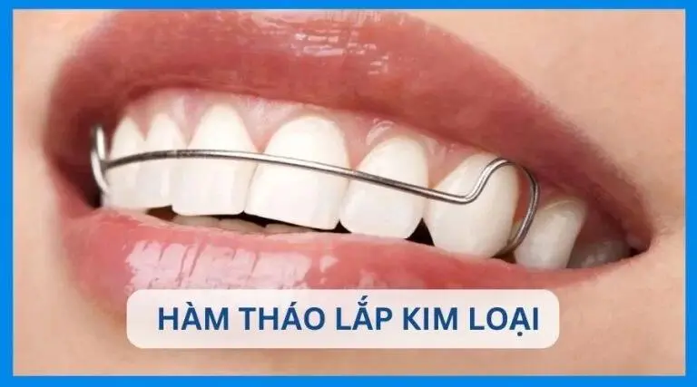 Hàm duy trì là gì? Có mấy loại? 5 điều bạn nên biết ! 7 hàm duy trì tháo lắp