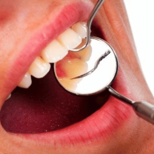 Hình ảnh viêm lợi qua các giai đoạn giúp nhận biết sớm !