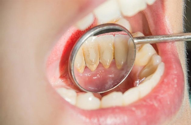 lấy cao răng có đau không