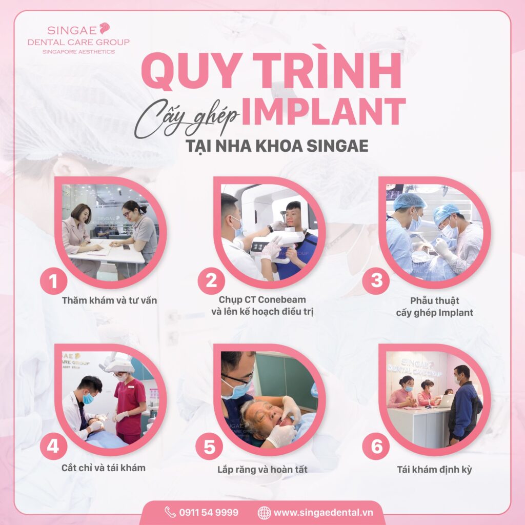 Giải đáp: Khi nào nên trồng răng Implant? 7 quy trình trồng răng Implant