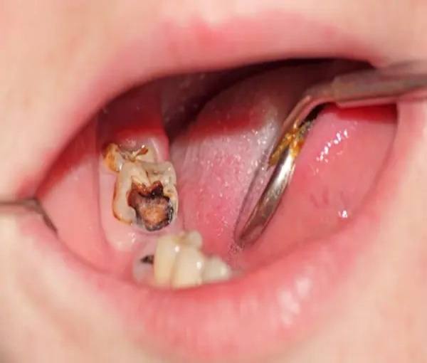 Sâu răng hàm : Các mức độ và cách điều trị dứt điểm 9 sâu răng hàm lan đến tủy