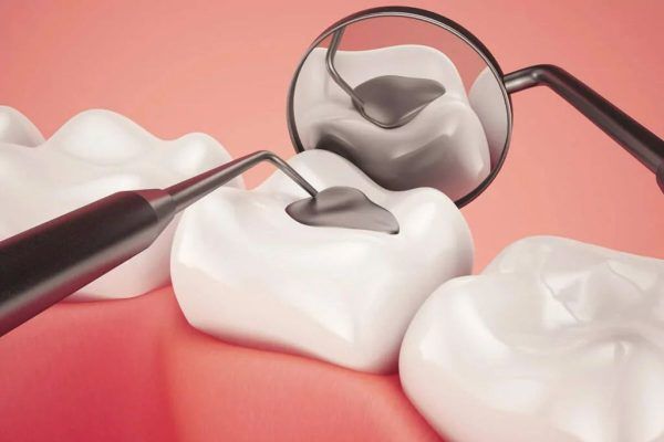 Sâu răng hàm : Các mức độ và cách điều trị dứt điểm 10 trám răng hàm bị sâu