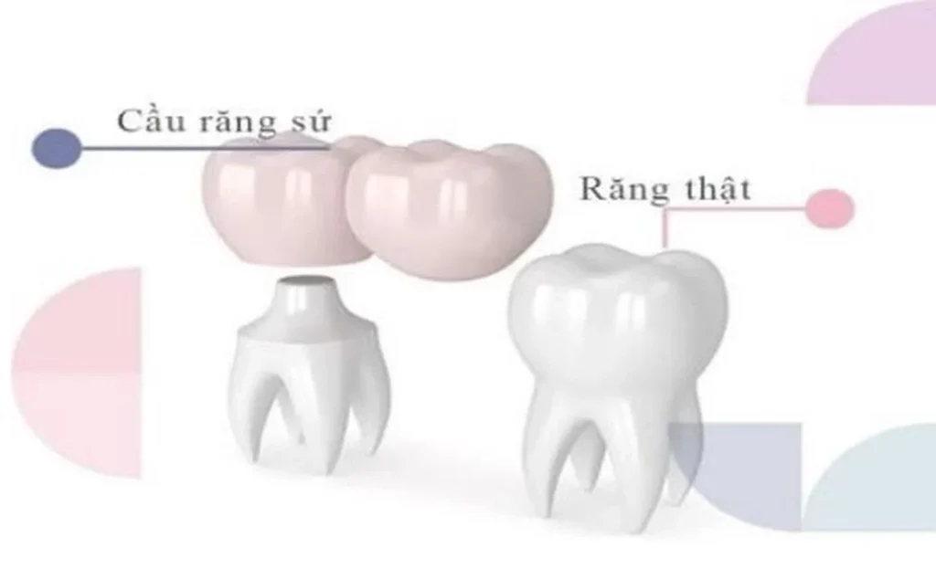Cầu răng sứ đèo
