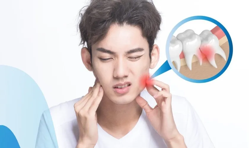 Chi phí nhổ răng khôn có được bảo hiểm y tế chi trả không?