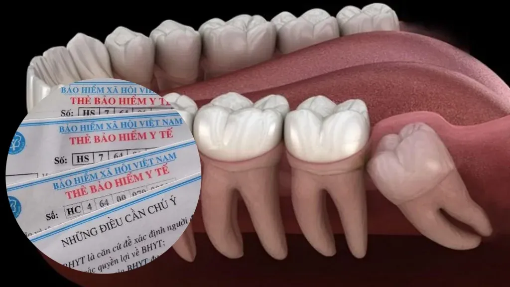 Chi phí nhổ răng khôn có được hưởng bảo hiểm y tế không