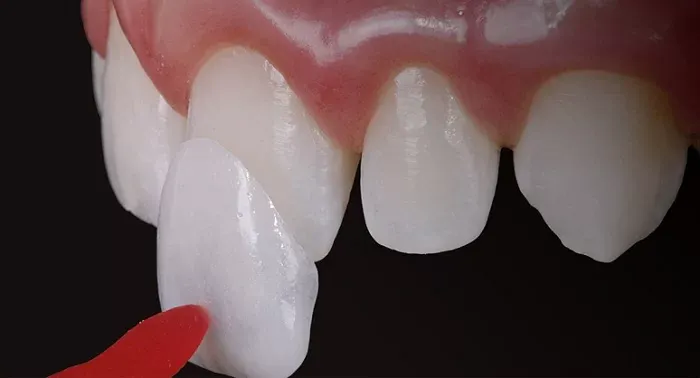 Dán răng sứ là gì? Có nên dán răng sứ không, ưu nhược điểm 8 dán răng sứ