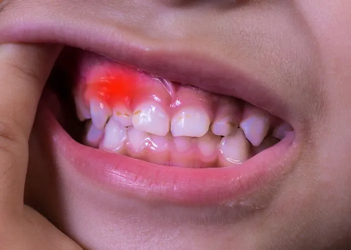 Dấu hiệu viêm nướu ở trẻ em