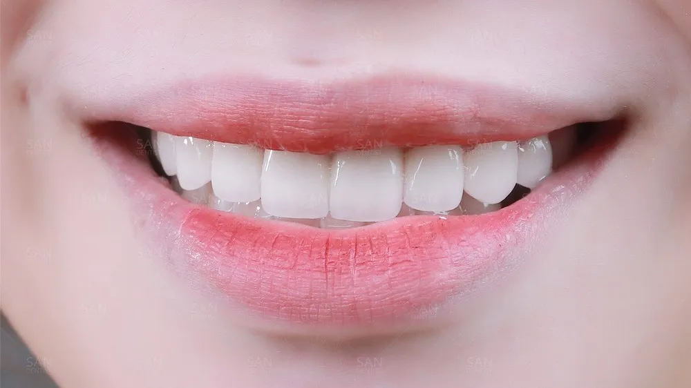 5 cách có nụ cười đẹp đơn giản , ai cũng bị thu hút 12 Hàm răng đều đặn