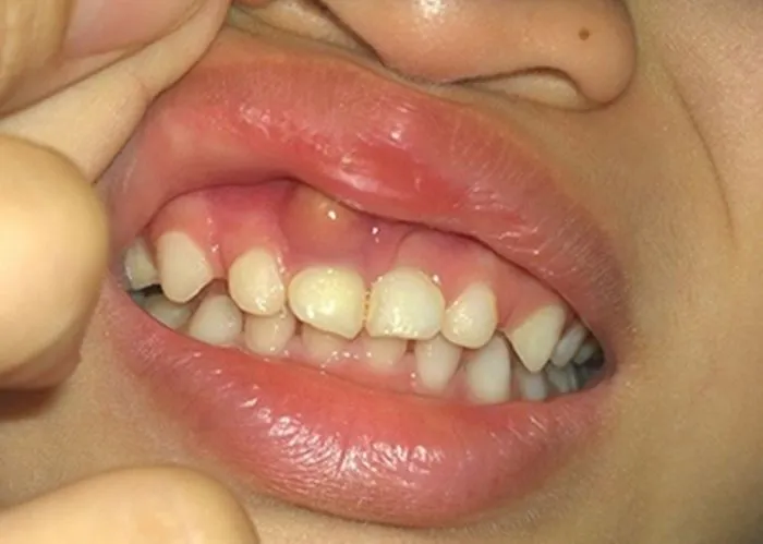 Hình ảnh nướu răng bị sưng