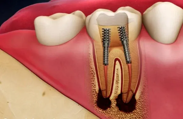 Hình ảnh viêm tủy răng giúp bạn sớm nhận biết và điều trị