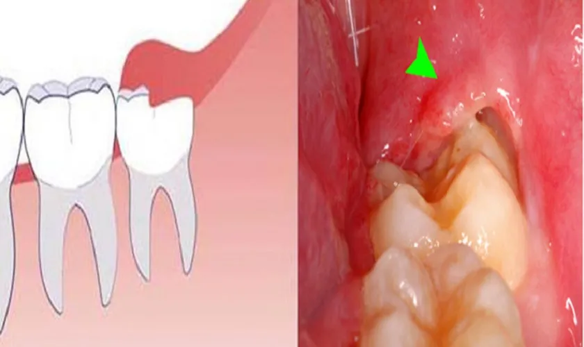 Khi nào cần phải nhổ răng số 8