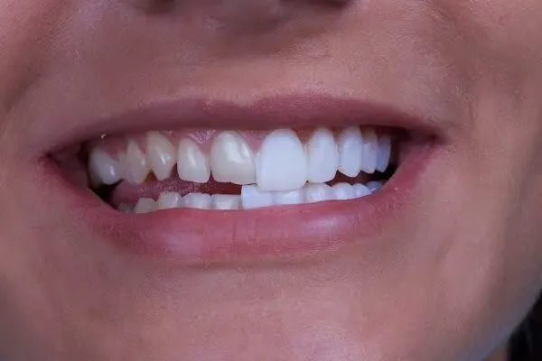 Dán răng sứ là gì? Có nên dán răng sứ không, ưu nhược điểm 9 Khi nào nên dán sứ veneer