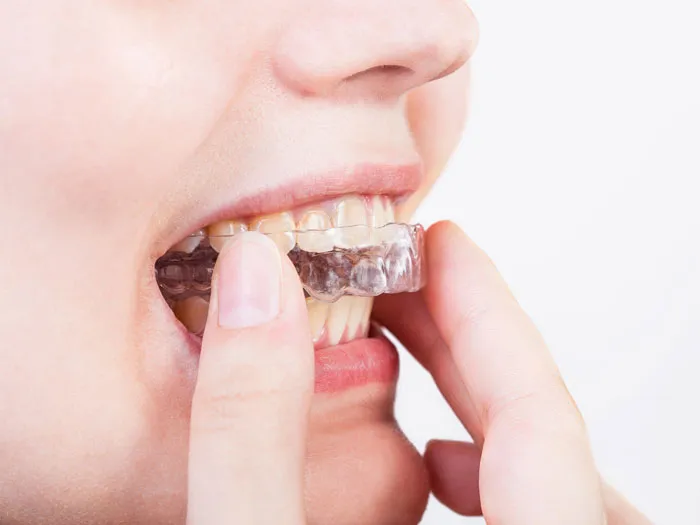Lưu ý khi sử dụng máng chống nghiến răng