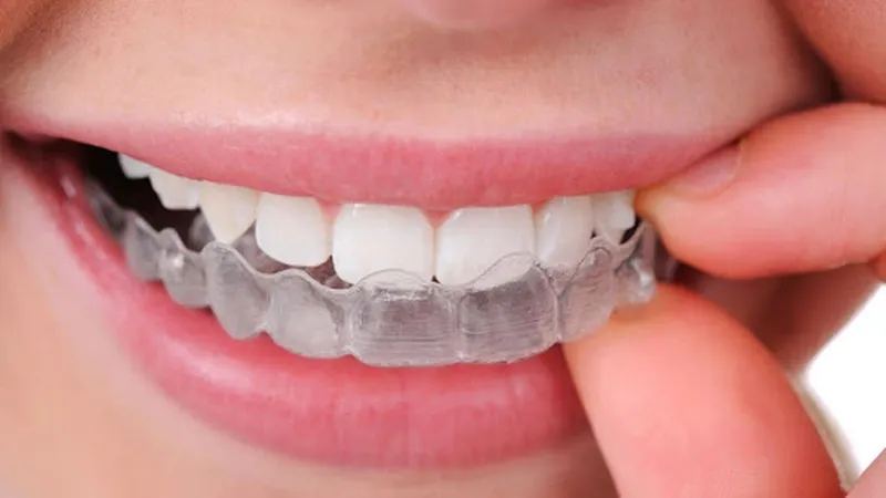 máng chống nghiến răng