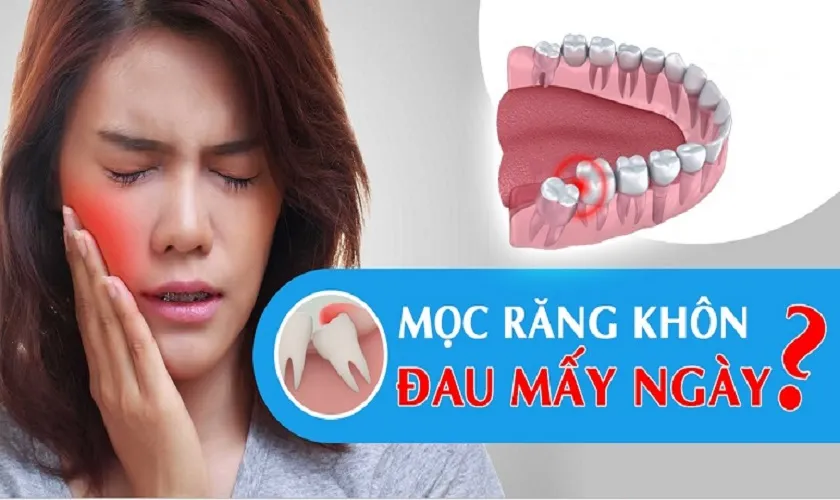 Mọc răng khôn đau mấy ngày? 3 Cách giảm đau nhanh chóng