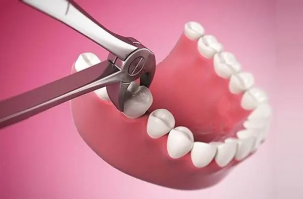 Mức hưởng bảo hiểm y tế khi nhổ răng khôn