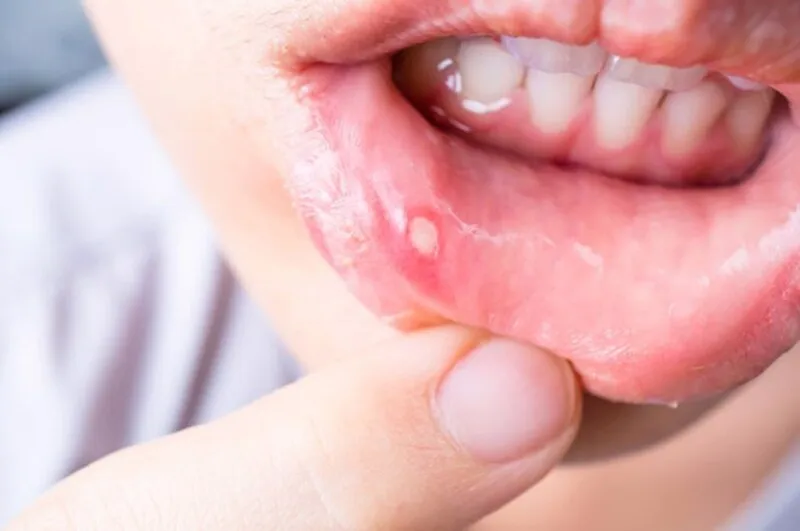 Nhiệt miệng là gì
