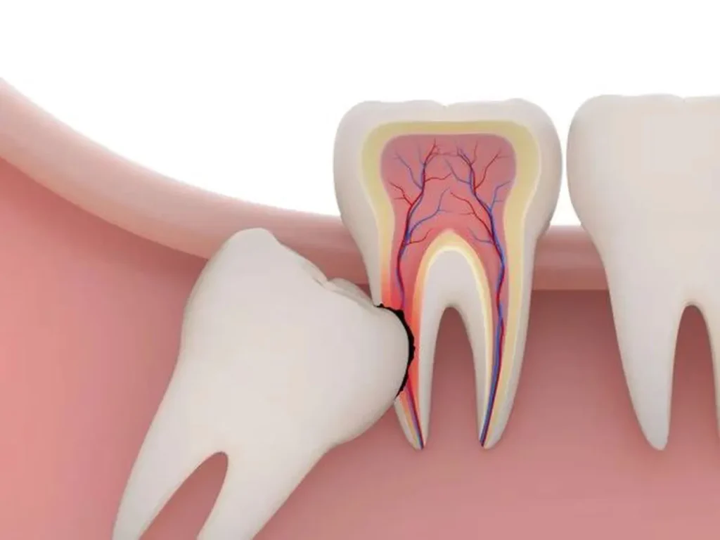 Nhổ răng khôn có nguy hiểm không? 9 biến chứng và lưu ý 7 Nhổ răng khôn có nguy hiểm không