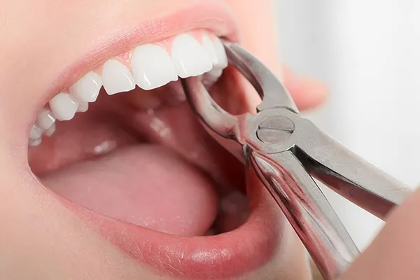Nhổ răng khôn có nguy hiểm không? 9 biến chứng và lưu ý 10 Những điều cần lưu ý sau khi nhổ răng số 8