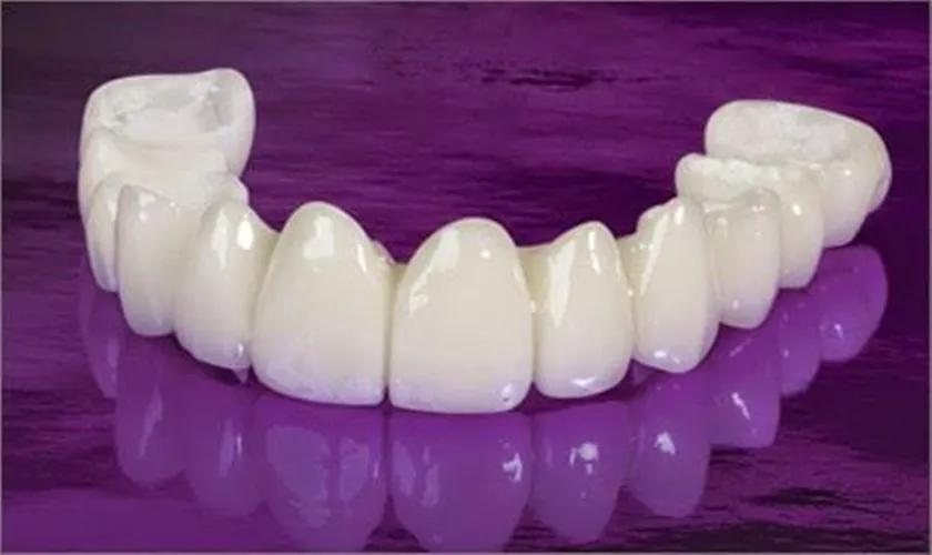 Răng sứ Cercon có tốt không? Giá bao nhiêu? Có mấy loại? 12 Răng sứ Cercon giá bao nhiêu