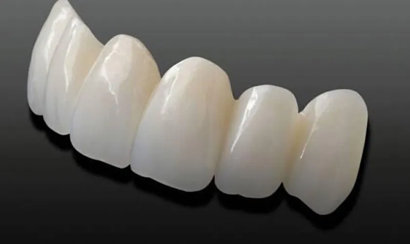 Răng sứ Cercon có tốt không? Giá bao nhiêu? Có mấy loại? 8 răng sứ Cercon
