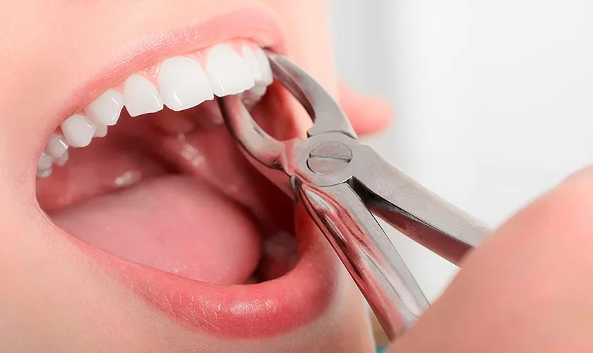Sau khi nhổ răng khôn cần lưu ý gì