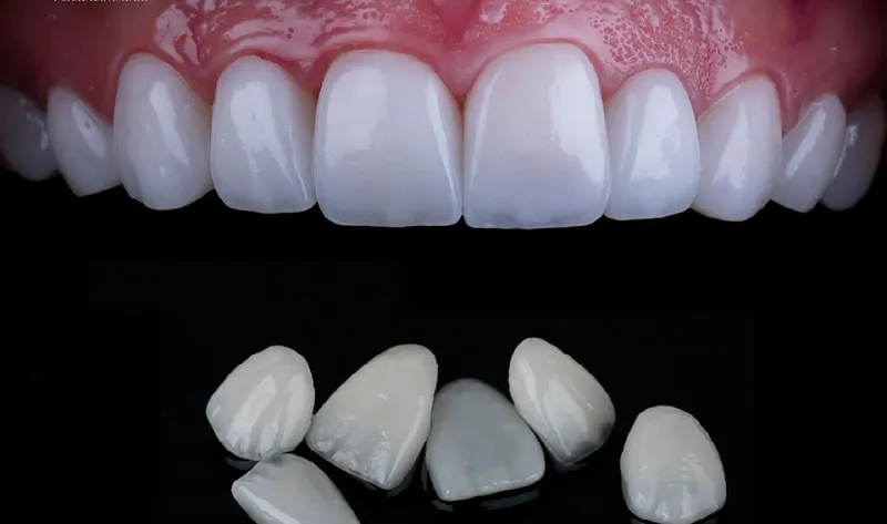 Dán răng sứ là gì? Có nên dán răng sứ không, ưu nhược điểm 13 Tác hại của dán răng sứ